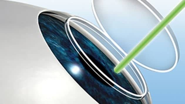 When Might LASIK Enhancements be needed?